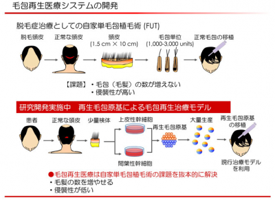 脱毛症治療