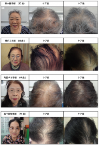 加齢による薄毛